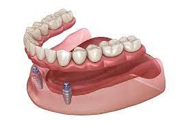 How Many Implants Are Needed for Implant Supported Dentures? - Chalfont  Dental Care Chalfont Pennsylvania